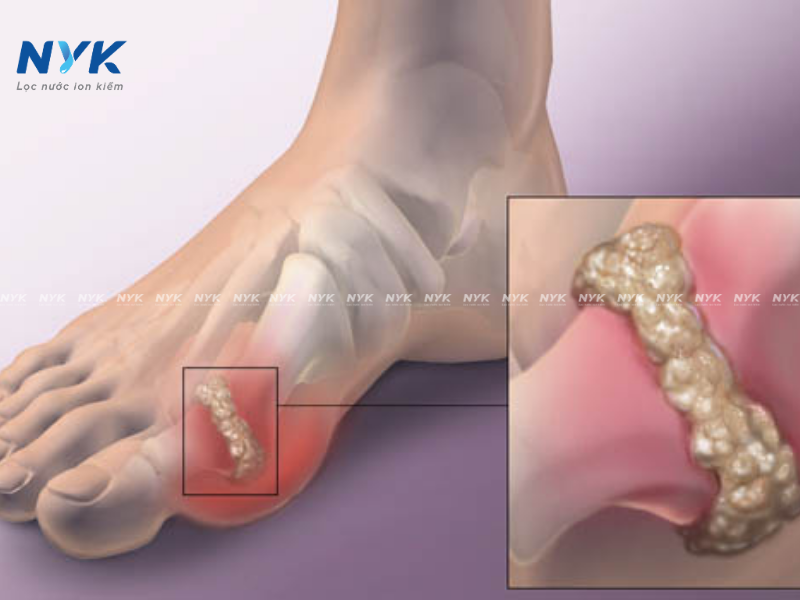 Bệnh Gút Kiêng Ăn Gì? Tìm Hiểu Chế Độ Dinh Dưỡng Và Vai Trò Của Nước Kiềm Trong Điều Trị Bệnh Gút