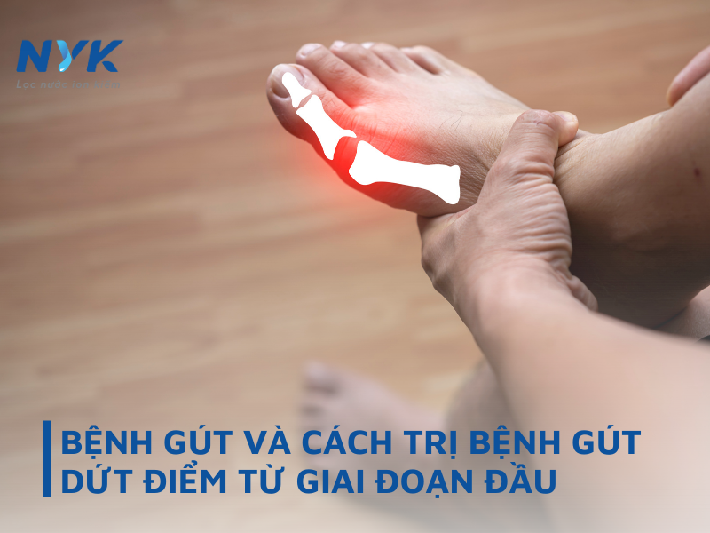 Bệnh Gút Và Cách Trị Bệnh Gút Dứt Điểm Từ Giai Đoạn Đầu