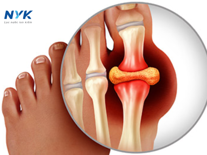 Đặc Điểm Giai Đoạn Đầu Của Bệnh Gút (Gout)