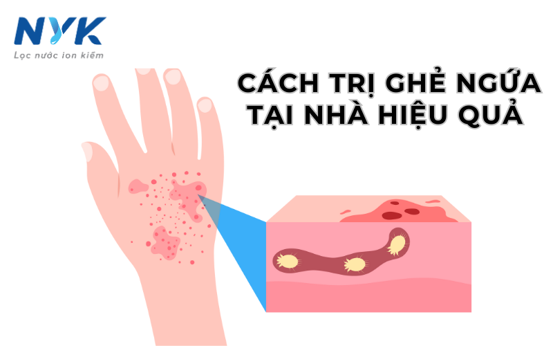 5 Cách Trị Ghẻ Ngứa Tại Nhà – Phương Pháp Tự Nhiên Giúp Làn Da Khỏe Mạnh