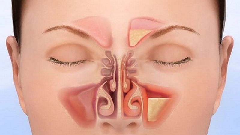 Mẹo Chữa Ngạt Mũi Trong 20 Giây: Cách Đơn Giản và Hiệu Quả Ngay Tức Thì